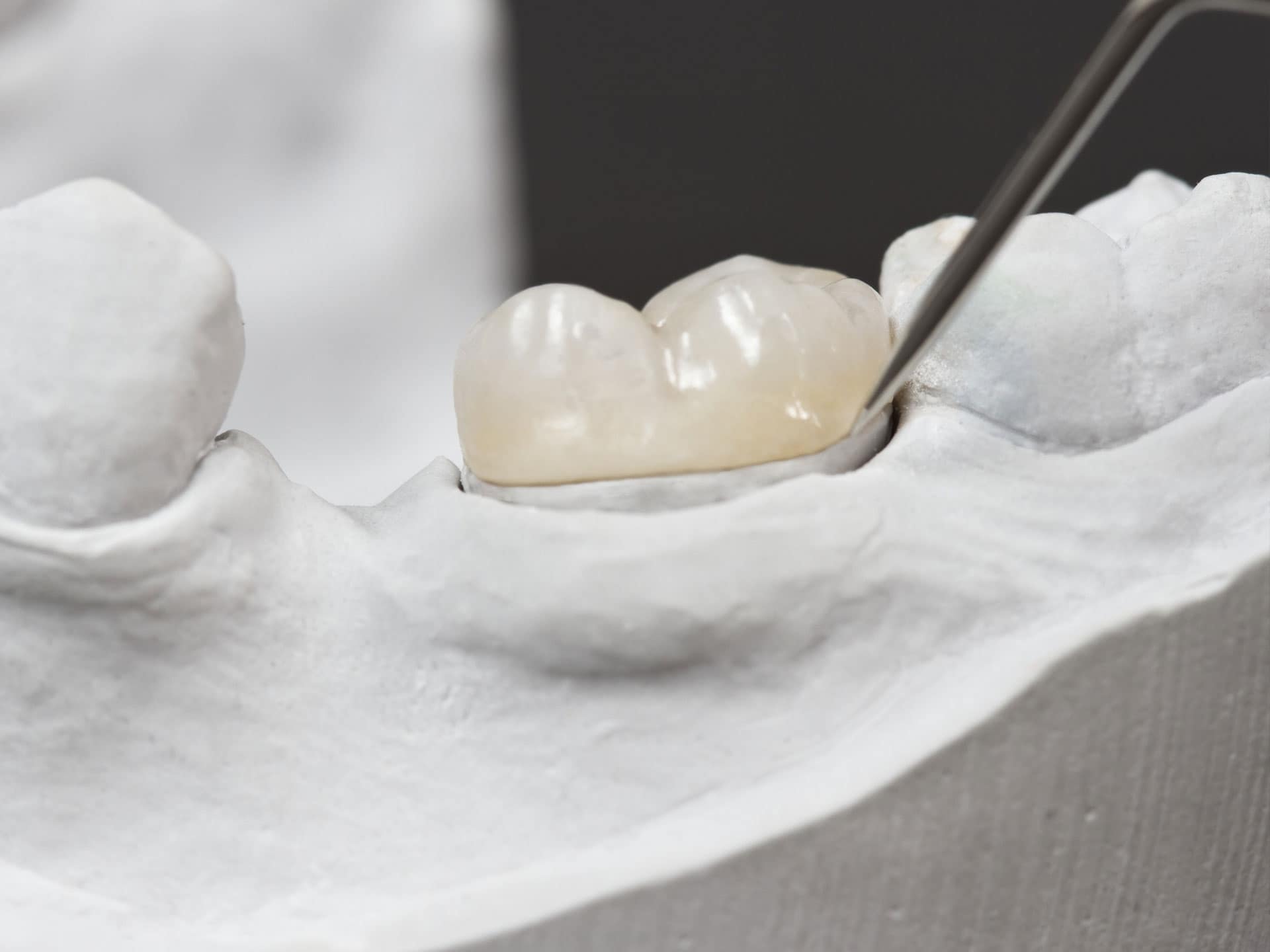 Inlay - Onlay - Abay Dental